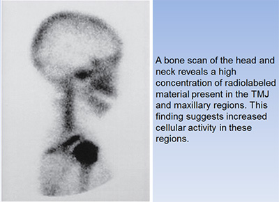 tmj bone scan tmj bone scan