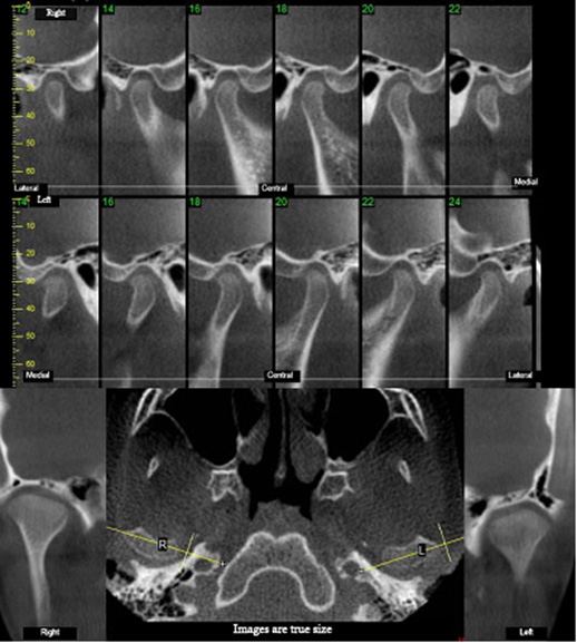 tmj cone beam scan tmj cone beam scan