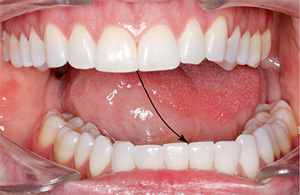 tmj deflections tmj deflections