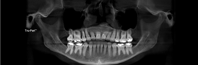 tmj dental panoramic radiograph tmj dental panoramic radiograph