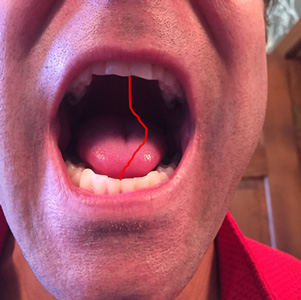 tmj deviations tmj deviations
