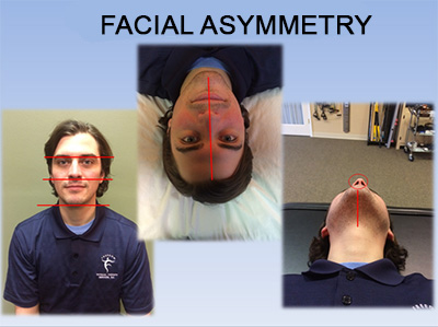tmj facial asymmetry tmj facial asymmetry