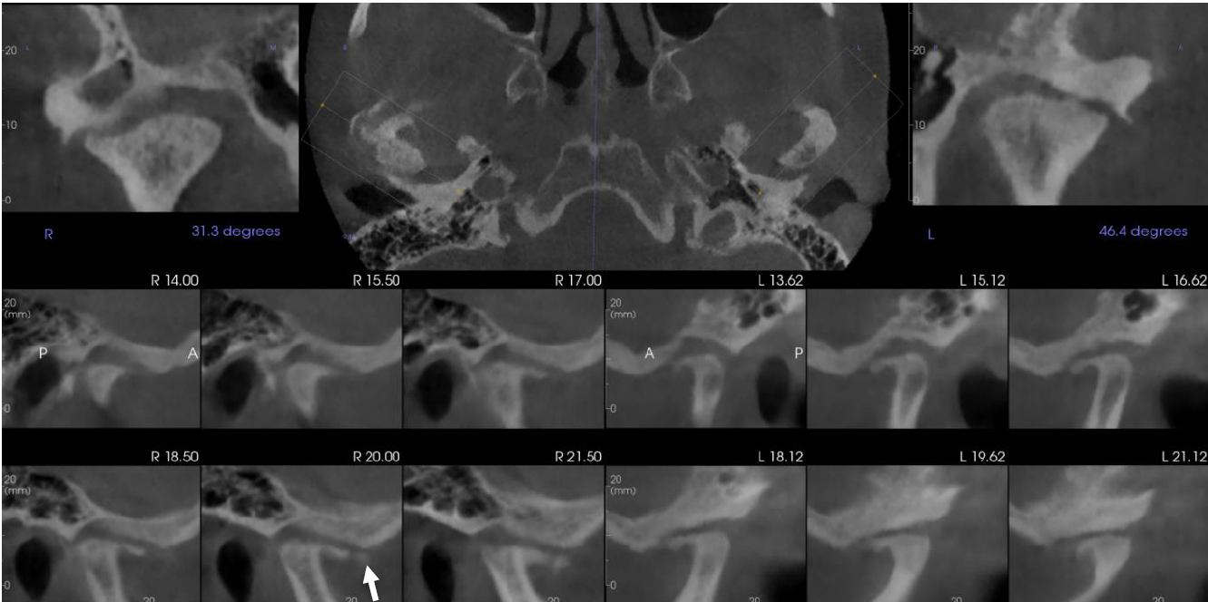 image2 TMJs, coronal, axial and sagittal views, teeth clenched.