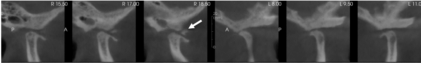 image4 TMJs, sagittal view, mouth open.