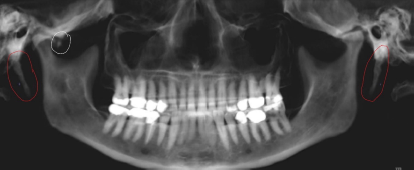 image5 calcified stylohyoid process on both sides