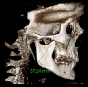 image6 calcified stylohyoid process on both sides