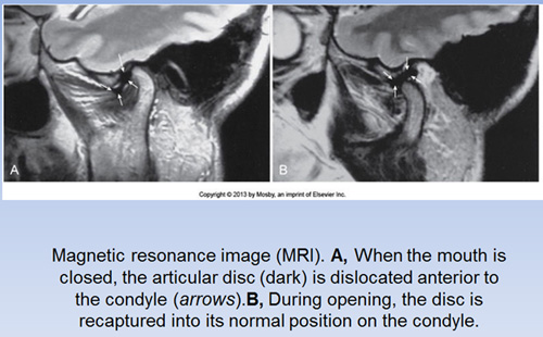 tmj mri scan tmj mri scan