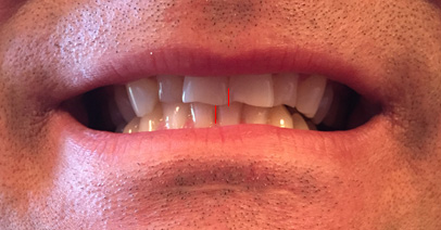 tmj teeth alignment tmj teeth alignment
