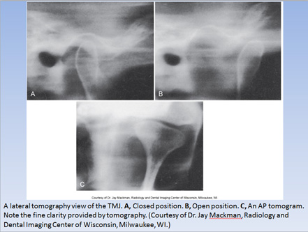 tmj tomogram tmj tomogram