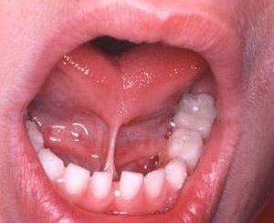 tmj tongue lip tmj tongue lip